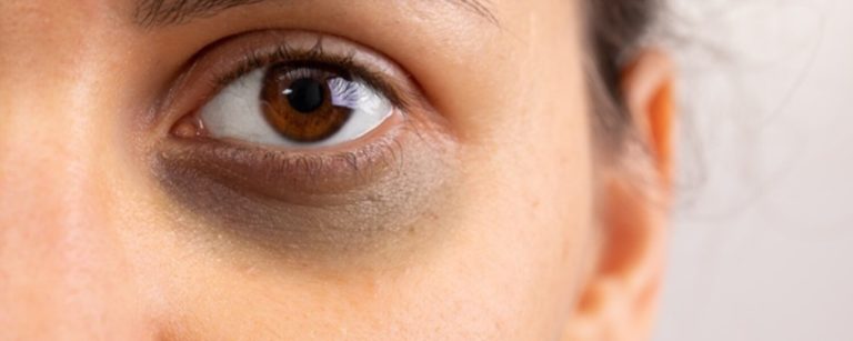 Dark circles due to less sleep